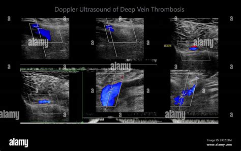 Dvt Us Radiopedia
