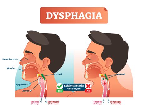 Read Dysphagia Diagnosis And Treatment 