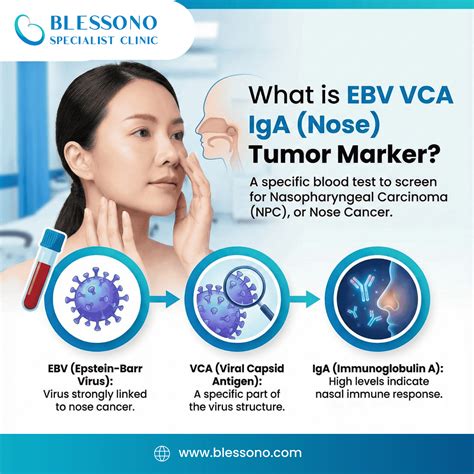Ebv Vca ıgm Nedir