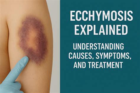 Ecchymosis Meaning