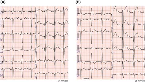 Ecg After Pacing
