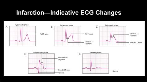 Ecg Changes In Mi