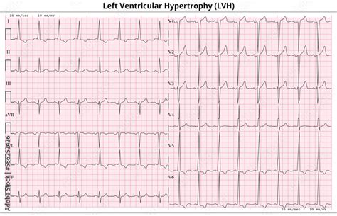 Ecg In Lvh
