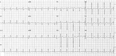 Ecg Of Pe