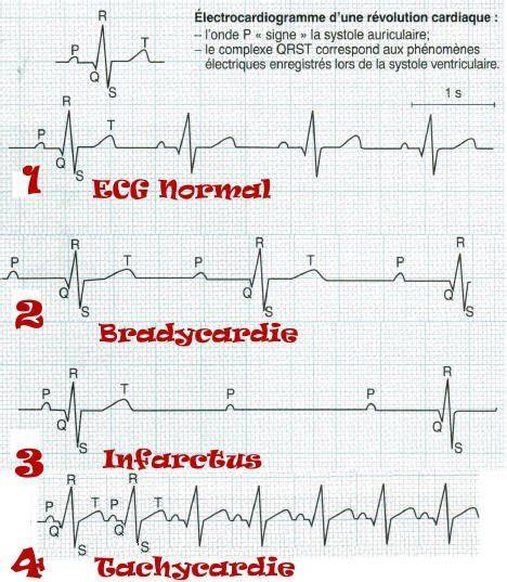 ecg pathologique de la tha c orie a la pratique 1