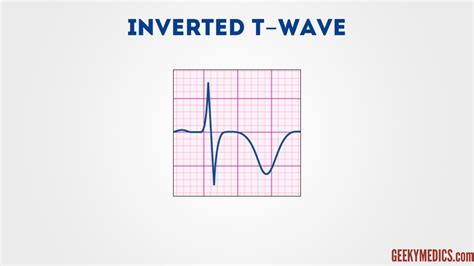 Ecg T Wave Inversion