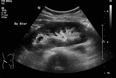 echografie van de nieren