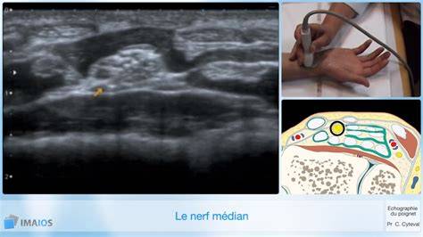 echographie du poignet et de la main