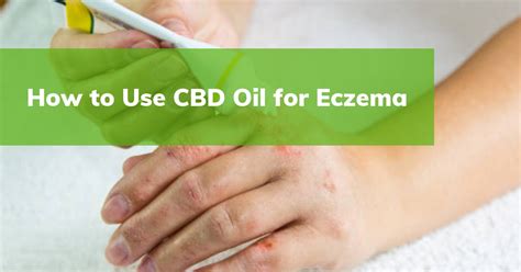 eczema cbd
