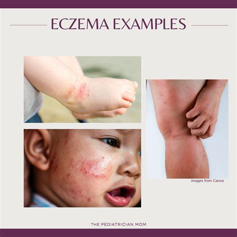 Read Online Eczema The Basics 