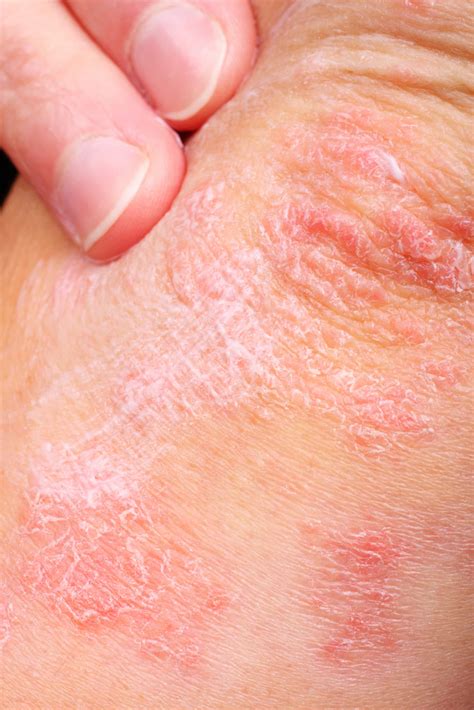 eczema - eczema fotos