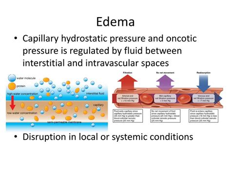 Edema Hydrostatic Pressure