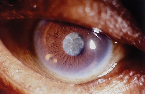 Effective Cataract Surgical Coverage In Adults Aged 50 Years And Older  Estimates From Population Based Surveys In 55 Countries - Rumus Panama 24