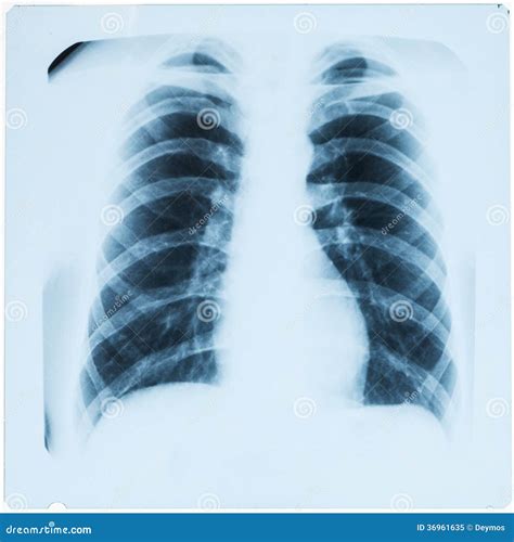 efter lunginflammation