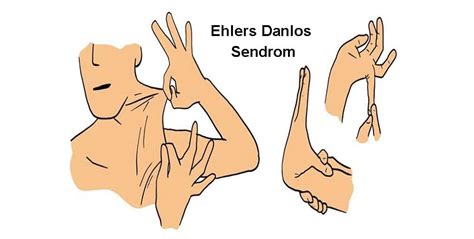 Ehler Danlos Sendromu