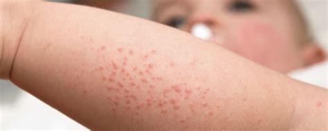 eikenprocessierups uitslag