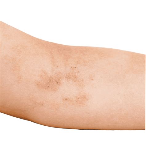 eksem  vilket  förmå  detta bero på