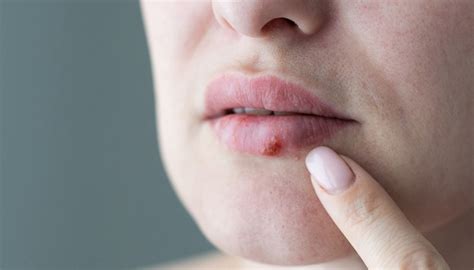 eksem runt munnen behandling