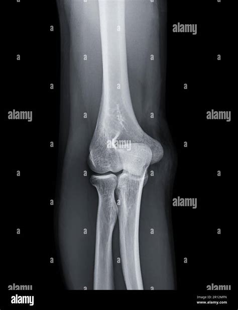 Elbow X Ray