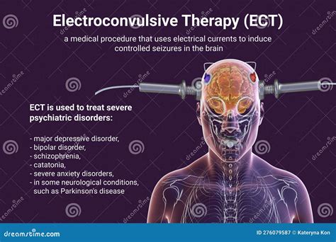 Electro Compulsive Therapy