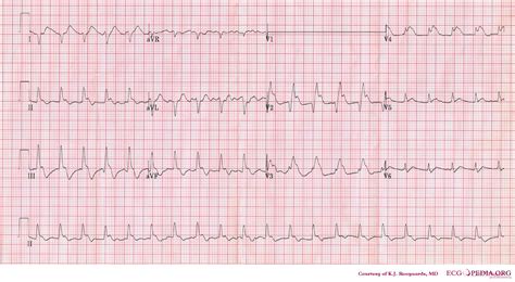 Electrocardiogram Pulmonary Embolism