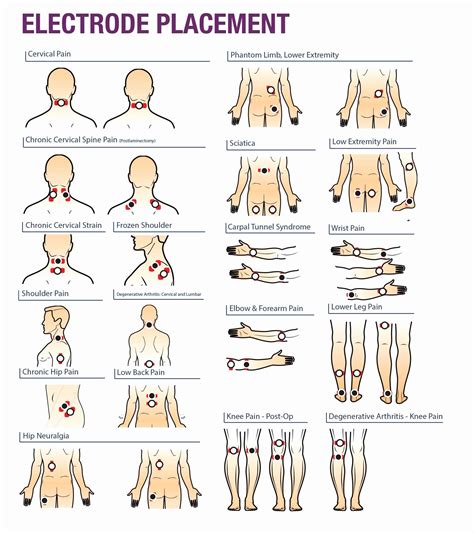 Read Online Electrode Placement Manual For Tens 