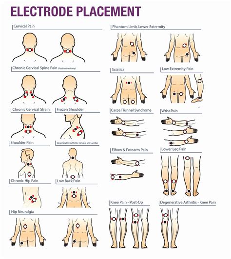 Read Online Electrode Placement Manual For Tens 