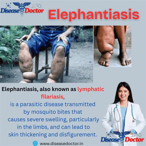 Elephantiasis Of Nuts