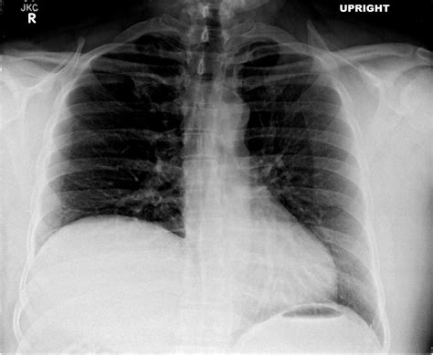 Elevation Of The Hemidiaphragm