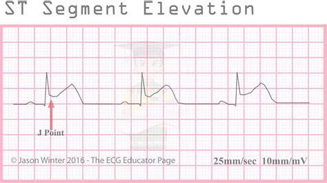 Elevation St Segment