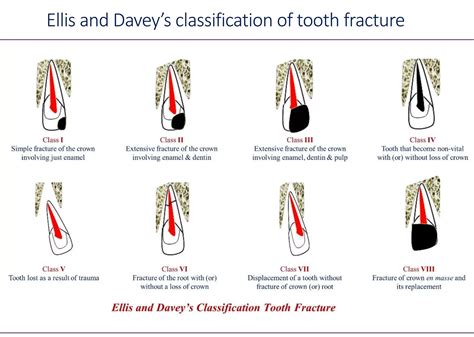 Ellis Fracture Classification