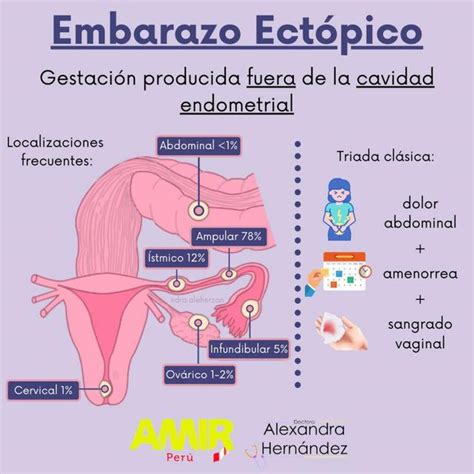 Embarazo Ectópico Gpc