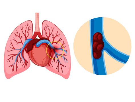 Embolia Pulmonar Maciça