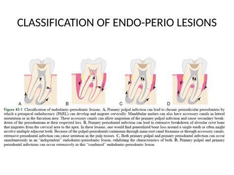 endo perio mcq