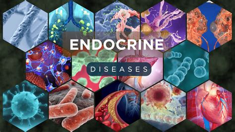 Endocrine Diseases
