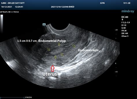 Endometrial Polyp Usg