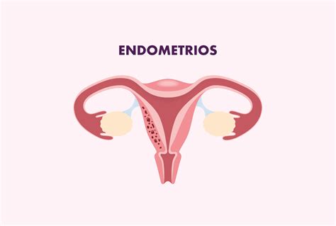endometrios