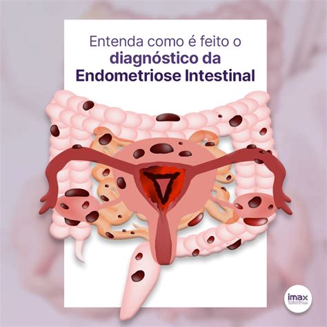 endometriose no intestino