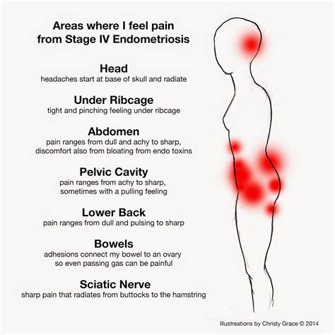 Endometriosis Back Pain