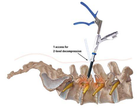 endoscopic procedures on the spine