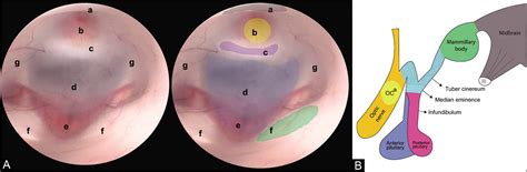 Read Endoscopic Anatomy Of The Third Ventricle Microsurgical And Endoscopic Approaches 
