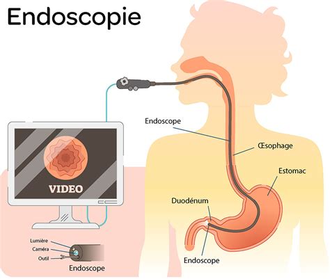 endoscopie definitie