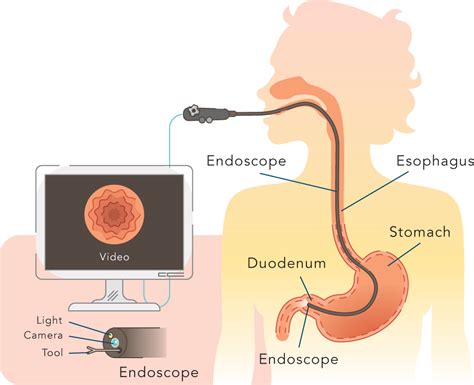 Endoscopy Of The Upper Gi Tract Endoscopy Cogenv