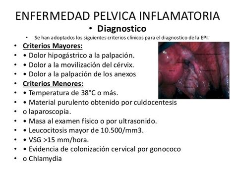 enfermedad pelvica inflamatoria cie 10