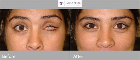 Enucleation Of Eyeball