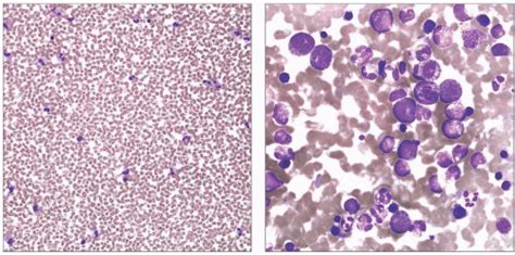 eosinophilia Basicmedical Key