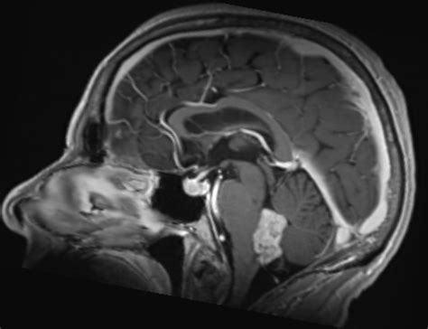 ependymom överlevnad