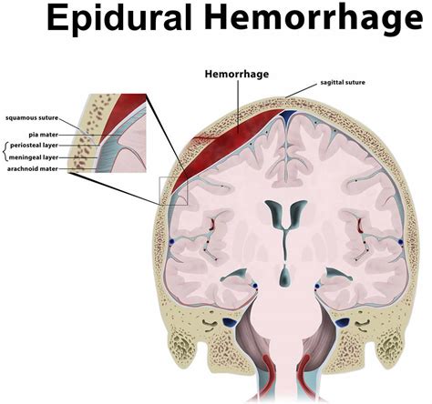 epidoral hematoma