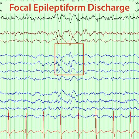 epileptiform discharge 뜻