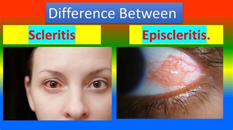 Episcleritis Vs Scleritis